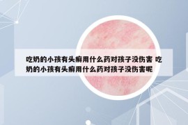 吃奶的小孩有头癣用什么药对孩子没伤害 吃奶的小孩有头癣用什么药对孩子没伤害呢