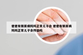 爸爸有银屑病妈妈正常儿子会 爸爸有银屑病妈妈正常儿子会传染吗