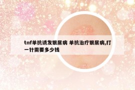 tnf单抗诱发银屑病 单抗治疗银屑病,打一针需要多少钱