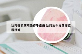 沈阳哪家医院治疗牛皮癣 沈阳治牛皮屑哪家医院好