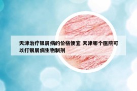 天津治疗银屑病的价格便宜 天津哪个医院可以打银屑病生物制剂