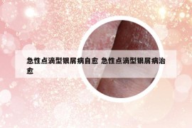 急性点滴型银屑病自愈 急性点滴型银屑病治愈