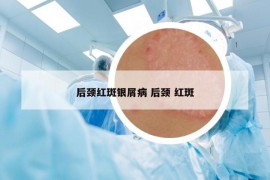 后颈红斑银屑病 后颈 红斑