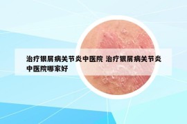 治疗银屑病关节炎中医院 治疗银屑病关节炎中医院哪家好