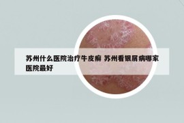 苏州什么医院治疗牛皮癣 苏州看银屑病哪家医院最好