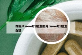 白癜风wood灯检查图片 wood灯检查白斑