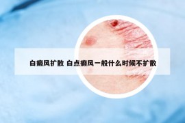 白癜风扩散 白点癫风一般什么时候不扩散