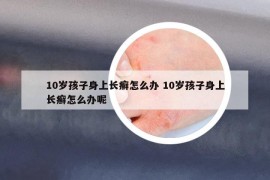 10岁孩子身上长癣怎么办 10岁孩子身上长癣怎么办呢