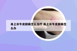 身上长牛皮肤癣怎么治疗 身上长牛皮肤癣怎么办