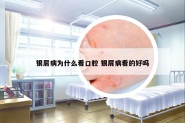 银屑病为什么看口腔 银屑病看的好吗