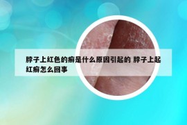 脖子上红色的癣是什么原因引起的 脖子上起红癣怎么回事