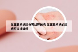 掌跖脓疱病脓包可以弄破吗 掌跖脓疱病的脓疱可以挑破吗