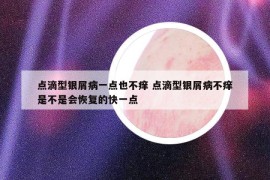 点滴型银屑病一点也不痒 点滴型银屑病不痒是不是会恢复的快一点