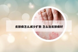 皮肤癣怎么减少扩散 怎么治皮肤癣好