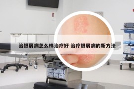 治银屑病怎么样治疗好 治疗银屑病的新方法