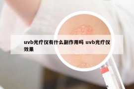 uvb光疗仪有什么副作用吗 uvb光疗仪效果