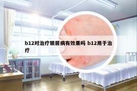 b12对治疗银屑病有效果吗 b12用于治疗