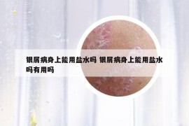 银屑病身上能用盐水吗 银屑病身上能用盐水吗有用吗