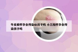 牛皮癣怀孕会传染给孩子吗 小三阳怀孕会传染孩子吗