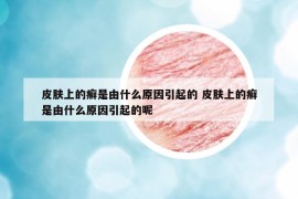 皮肤上的癣是由什么原因引起的 皮肤上的癣是由什么原因引起的呢