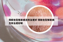 得脓包型银屑病怎样治更好 得脓包型银屑病怎样治更好呢