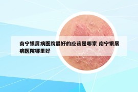 南宁银屑病医院最好的应该是哪家 南宁银屑病医院哪里好