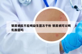 银屑病能不能喝益生菌冻干粉 银屑病可以喝乳酸菌吗