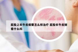 屁股上长牛皮癣要怎么样治疗 屁股长牛皮鲜看什么科