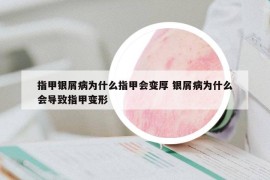 指甲银屑病为什么指甲会变厚 银屑病为什么会导致指甲变形