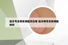 临汾专业银屑病医院在哪 临汾哪家皮肤病医院好