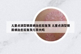 儿童点滴型银屑病治愈后复发 儿童点滴型银屑病治愈后复发几率大吗