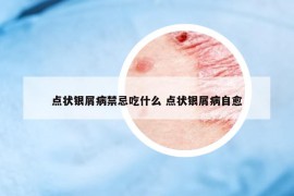 点状银屑病禁忌吃什么 点状银屑病自愈