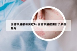 面部银屑病会自愈吗 面部银屑病用什么药膏最好