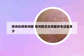 郑州白斑郑州西 郑州西京白斑医院电话是多少