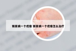 银屑病一个疙瘩 银屑病一个疙瘩怎么治疗