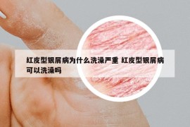 红皮型银屑病为什么洗澡严重 红皮型银屑病可以洗澡吗