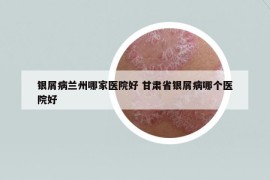 银屑病兰州哪家医院好 甘肃省银屑病哪个医院好