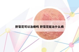 野菊花可以治癣吗 野菊花能冶什么病