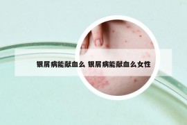 银屑病能献血么 银屑病能献血么女性