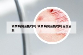 银屑病豌豆能吃吗 银屑病豌豆能吃吗百度百科