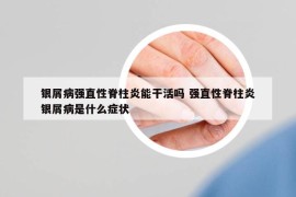 银屑病强直性脊柱炎能干活吗 强直性脊柱炎银屑病是什么症状