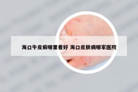 海口牛皮癣哪里看好 海口皮肤病哪家医院