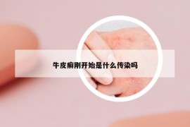 牛皮癣刚开始是什么传染吗