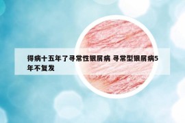 得病十五年了寻常性银屑病 寻常型银屑病5年不复发