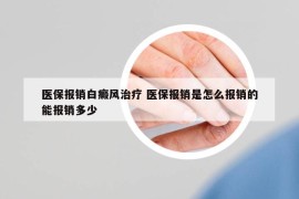 医保报销白癜风治疗 医保报销是怎么报销的能报销多少