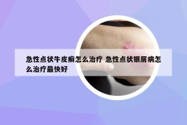 急性点状牛皮癣怎么治疗 急性点状银屑病怎么治疗最快好