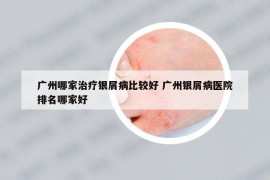 广州哪家治疗银屑病比较好 广州银屑病医院排名哪家好