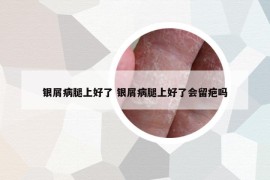 银屑病腿上好了 银屑病腿上好了会留疤吗