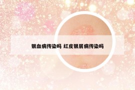 银血病传染吗 红皮银屑病传染吗