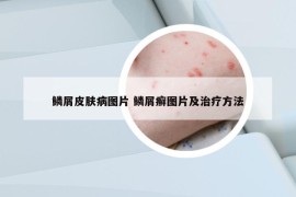 鳞屑皮肤病图片 鳞屑癣图片及治疗方法